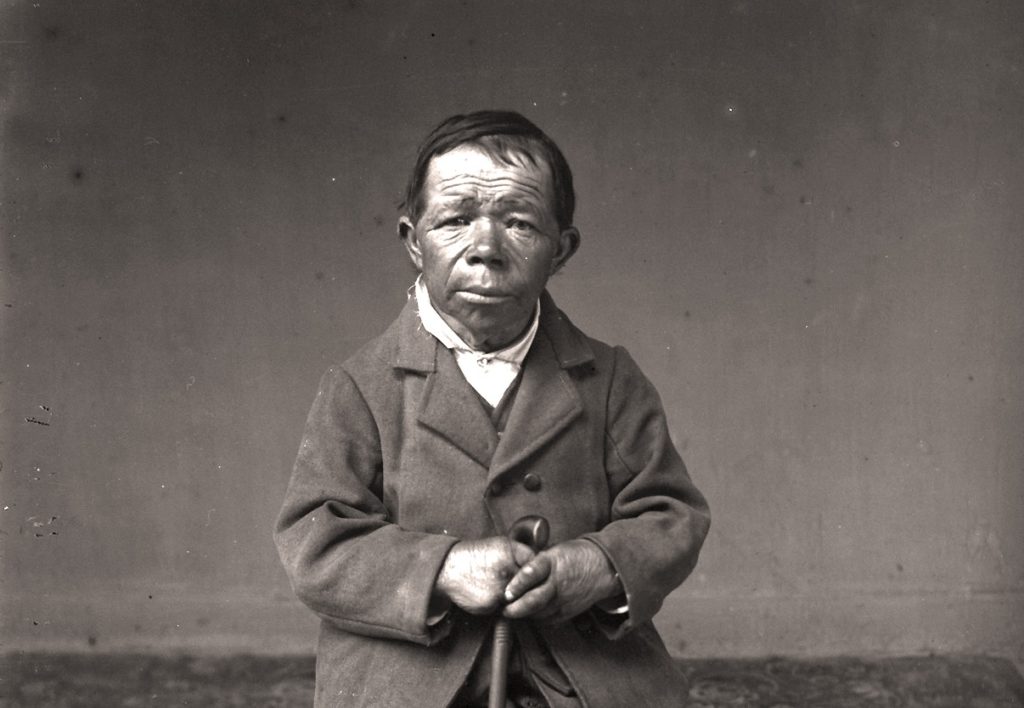 Der «Alpentrottel», eine medizinische und literarische Kuriosität